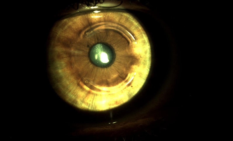 Ceratocone: implante de anel Ferrara para melhora da visão